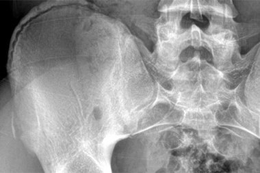 A 12-Year-Old Football Player with Sudden Hip Pain