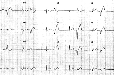 A 52-Year-Old Man Who Is Lightheaded and Dizzy