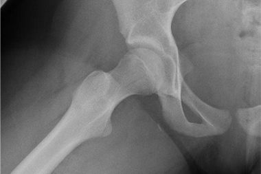 A 42-Year-Old Woman with Sudden Hip Pain