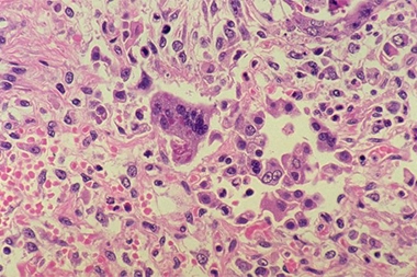 Update: Measles Cases Jump, This Time in the Northeast Update: Measles Cases Jump, This Time in the Northeast