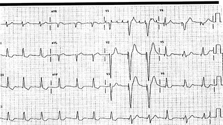 A 73-Year-Old Woman with a 12-Day History of Palpitations