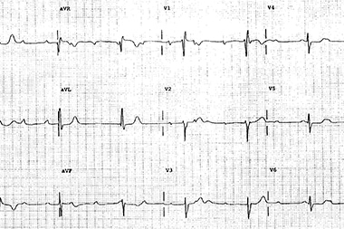 A 57-Year-Old Man with 3 Days of Lightheadedness