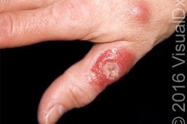 A 27-Year-Old Man with a Lesion on One Hand