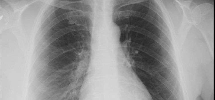 A 63-Year-Old Woman with a 4-Day History of Coughing
