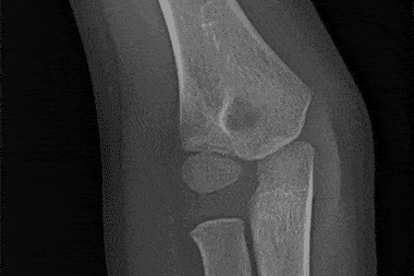 A 14-Year-Old Boy with Elbow Pain After a Fall on an Outstretched Hand