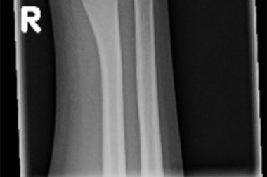 An 11-Year-Old Boy with Forearm and Wrist Pain After a Fall