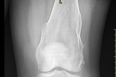 A 30-Year-Old Female with Bilateral Knee Pain