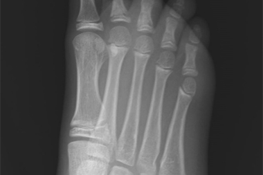 A 10-Year-Old Girl with Foot Pain After Falling from a Tree