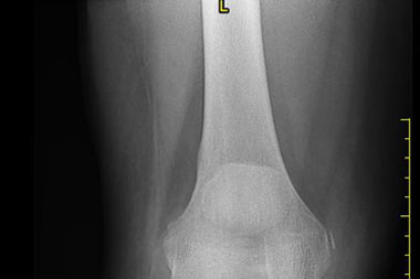 A 53-Year-Old Female with Painful, Swollen Medial Knee a Fall