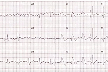 A 57-Year-Old Man with a Chief Complaint of Syncope 3 Hours Ago