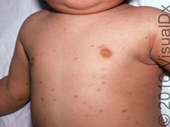 An 18-Month-Old with an Itchy Rash and Wheezing