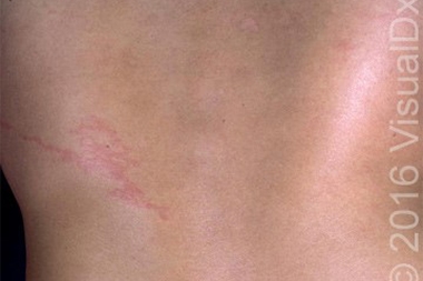 A 37-Year-Old Man with Multiple Symptoms Following a Trip to Japan