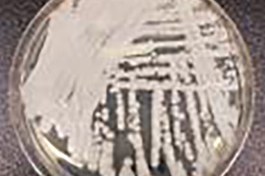 CDC: Resistant Candida auris is a ‘Serious Global Health Threat’; Is Your State Getting Hit?