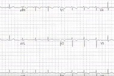 An 18-Year-Old Female with Sudden Sharp Chest Pain