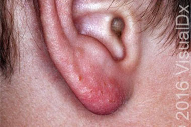 A 10-Year-Old Boy with Multiple Lesions on His Ear