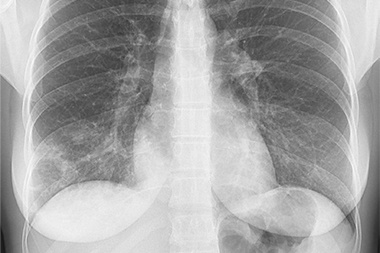 A 40-Year-Old Female with Progressively Worse Cough and Fever