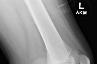 A 12-Year-Old Male with a 6-Month History of Knee Pain and Swelling