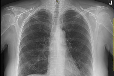 A 70-Year-Old Female with ‘Bony’ Pain in Her Chest