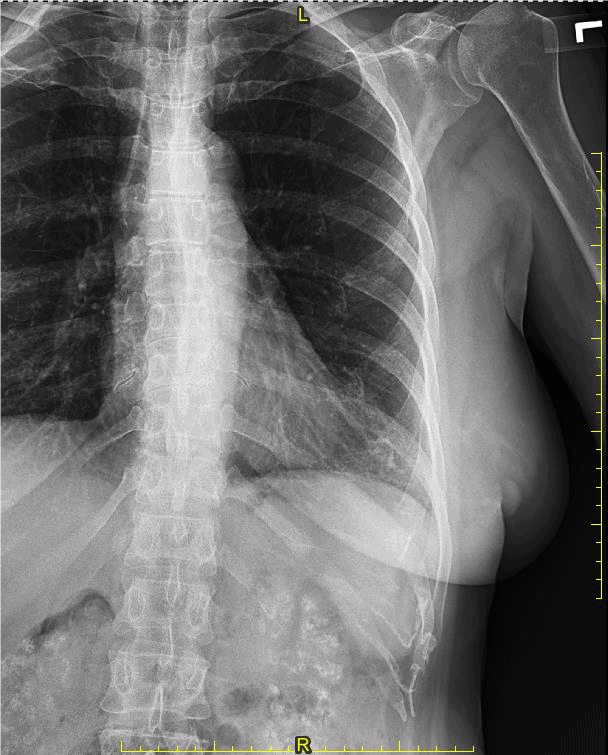 A 70YearOld Female with ‘Bony’ Pain in Her Chest Journal of Urgent
