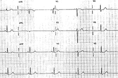 A 27-Year-Old Marathon Runner with Epigastric Pain