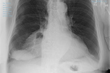 An 86-Year-Old Man with a Short History of Cough and Stomach Pain