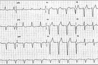 An 80-Year-Old Man with Rhinorrhea, Cough, and Intermittent Dizziness