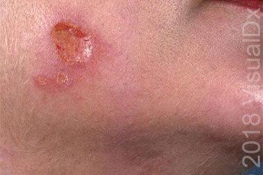 A 48-Year-Old Woman with a Facial Lesion