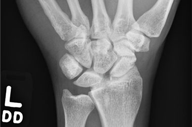 A 47-Year-Old Male with Chronic Wrist Pain and No Recent Trauma