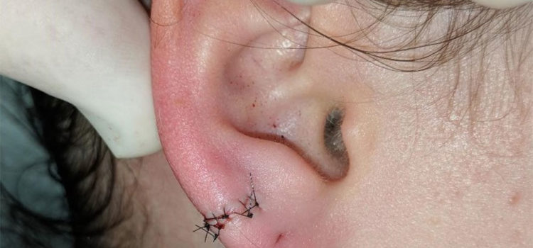 Repair of Split Earlobe Lacerations in the Urgent Care