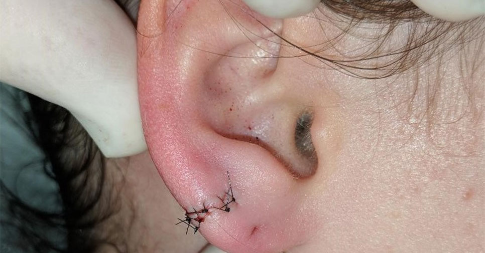 Ripped earlobe deals from earrings