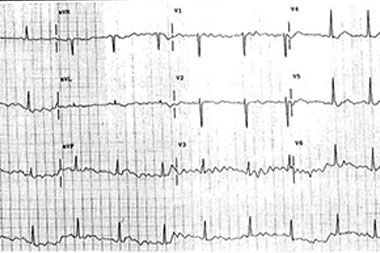 An 88-Year-Old Woman with Several Weeks of Dizziness