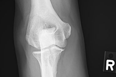 A 59-Year-Old Man with a Painful Elbow After a Fall A 59-Year-Old Man with a Painful Elbow After a Fall