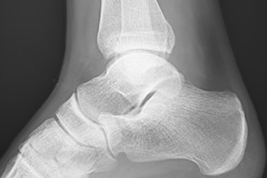 A 19-Year-Old with Acute Ankle Pain While Playing Hockey