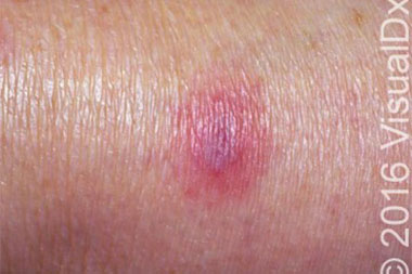 A 47-Year-Old Female Cancer Patient with Red, Flaccid Bullae on Her Leg