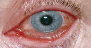 Urgent message: Urgent care is often the first stop for patients experiencing acute eye complaints, including conjunctivitis. The capability to accurately distinguish between infectious conjunctivitis of a viral nature vs that of a bacterial nature is essential to administering appropriate treatment and avoiding inappropriate use of antibiotics.