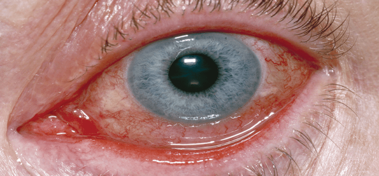 Evaluation of Infectious Conjunctivitis by Clinical Evaluation and Novel Diagnostics