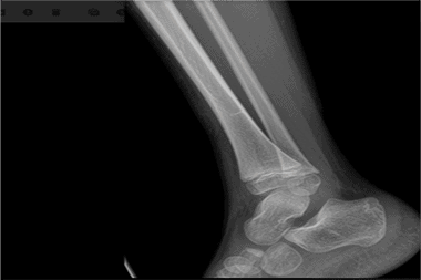 A 6-Year-Old Boy with Leg Pain After a Hard Impact