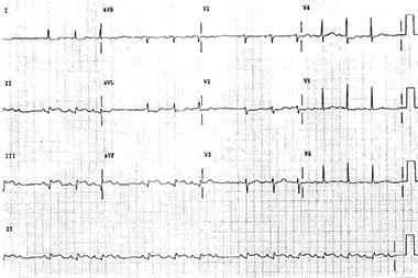 Multiple Findings Including STEMI, Low Voltage, and Type 2 AV Block in a 72-Year-Old Woman