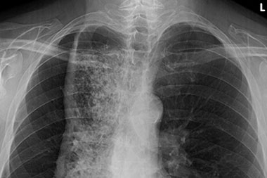 A 61-Year-Old Male with ‘Just a Cough’