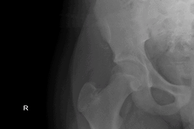 A 13-Year-Old Boy with Hip and Groin Pain After a Soccer Game