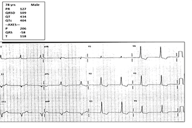 A 78-Year-Old with Dizziness and No Chest Pain, Shortness of Breath, or Diaphoresis A 78-Year-Old with Dizziness and No Chest Pain, Shortness of Breath, or Diaphoresis