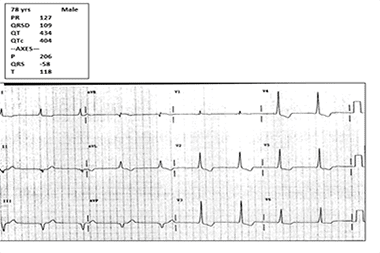 A 78-Year-Old with Dizziness and No Chest Pain, Shortness of Breath, or Diaphoresis