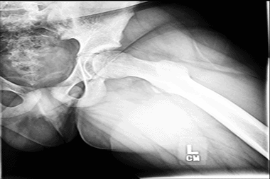 A 12-Year-Old Boy with Groin Pain