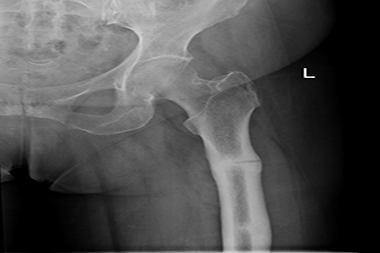 A 65-Year-Old Female with Hip Pain After a Stumble