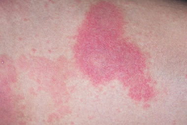 New Data Affirm Effective Treatment for Acute Urticaria