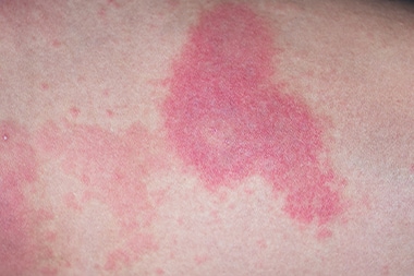 New Data Affirm Effective Treatment for Acute Urticaria