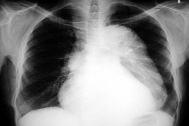 Free JUCM Webinar: 20 Questions—What You Can’t Afford to Miss in a Chest X-Ray