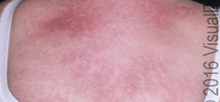 A 51-Year-Old Woman with Multiple Dermatological Symptoms and Muscle Weakness