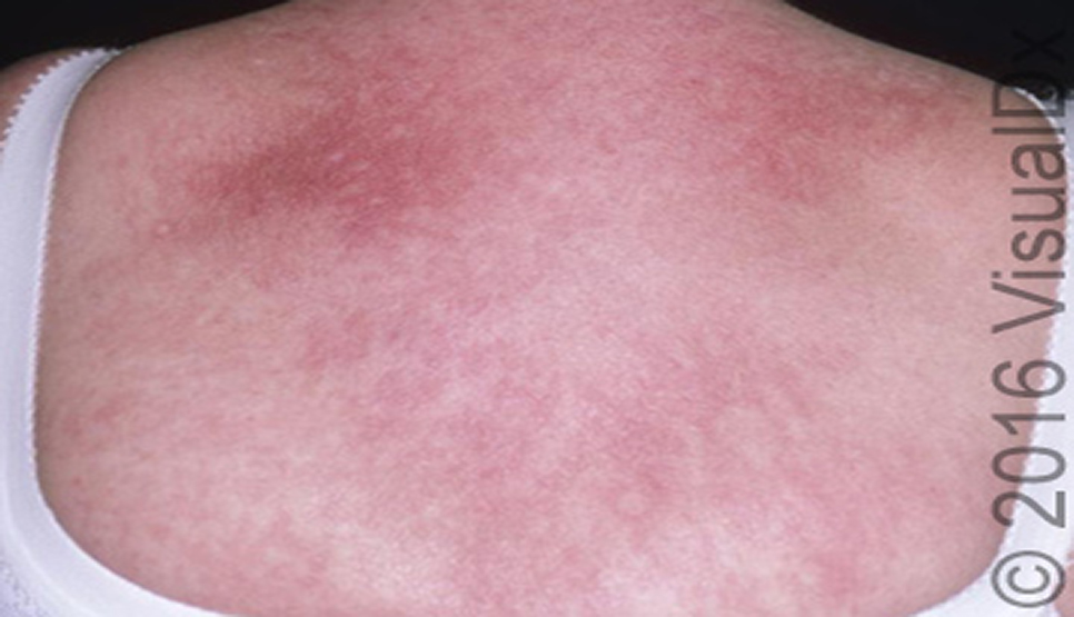 Lupus rash on chest