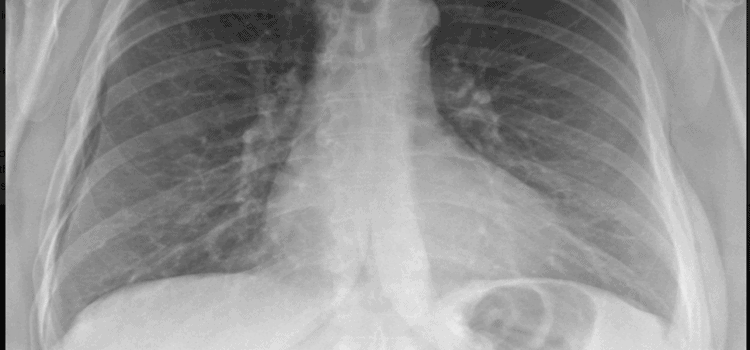 A 57-Year-OId Man with Rib Pain with Deep Breathing